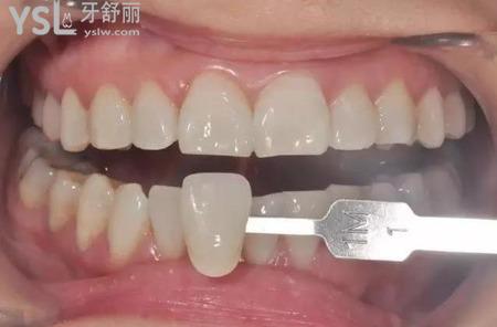 貼完牙貼牙齒酸睡不著怎么辦？
