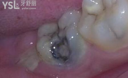 牙齒里面黑黑的是什么原因引起的？