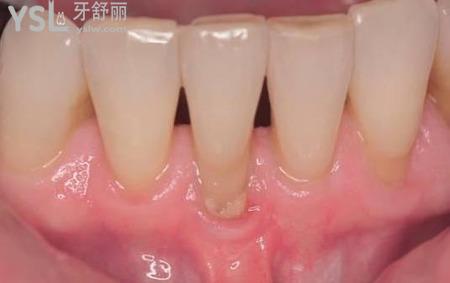 牙根長(zhǎng)在外面了怎么辦？
