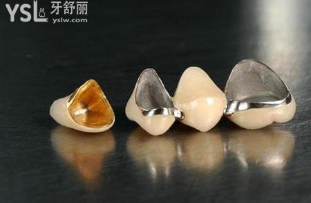 金屬牙和陶瓷牙哪個(gè)好？