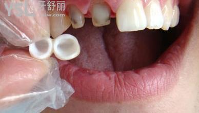 烤瓷牙裝好基牙咬合疼的原因是什么？