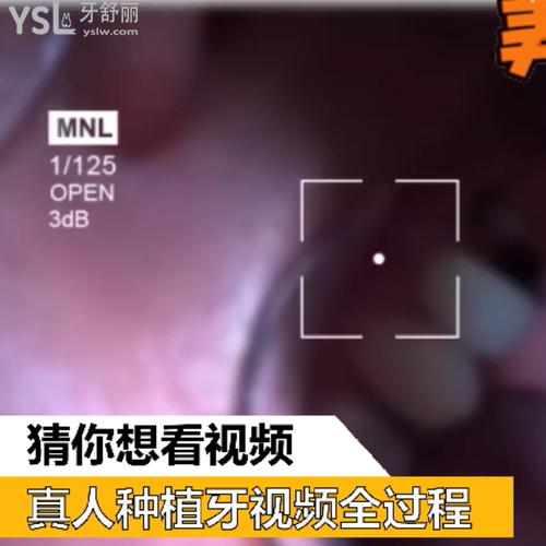 真人種植牙視頻全過程怎么樣？