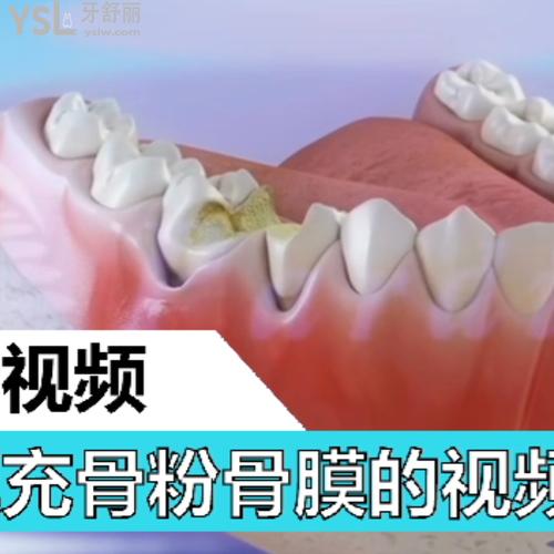 種植牙填充骨粉骨膜的視頻