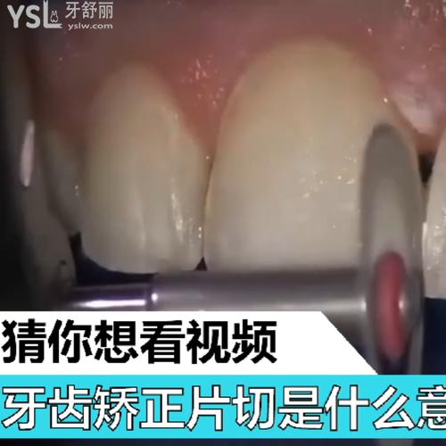 牙齒矯正片切是什么意思？