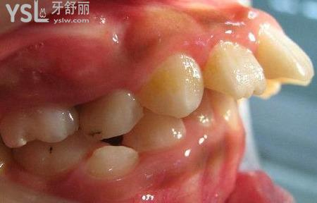 成年了牙齒慢慢往外凸怎么辦？