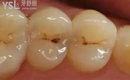 牙齒上有黑點(diǎn)是什么情況？