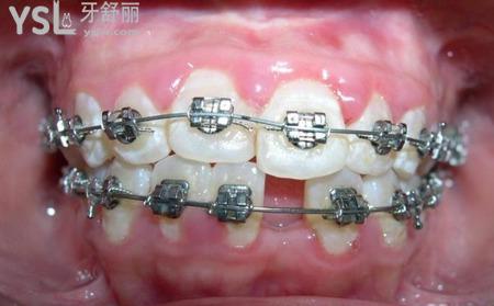 牙齒矯正的最晚年齡段是什么時候？