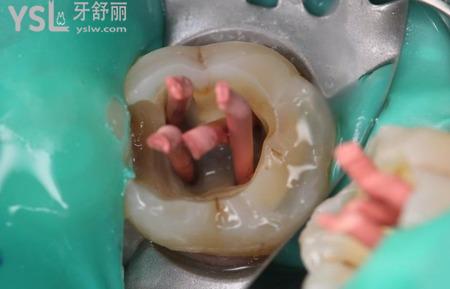 為什么牙髓炎突然不疼了怎么回事？