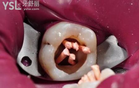 殺完神經(jīng)補牙疼嗎？
