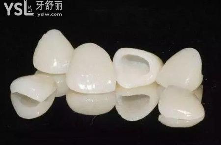全瓷牙的種類(lèi)有哪些？