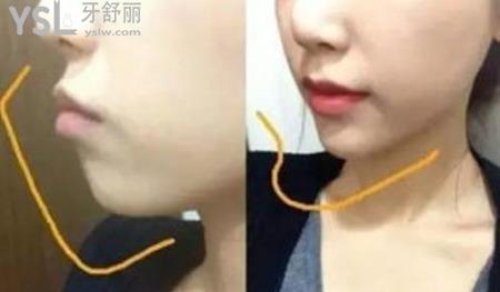 面部畸形矯正的方法是什么？