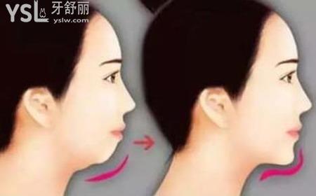 下頜骨歪斜能矯正嗎？