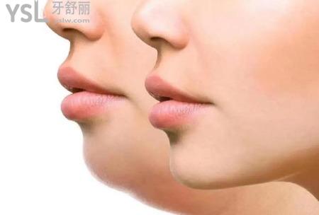 正頜手術(shù)風(fēng)險大嗎？