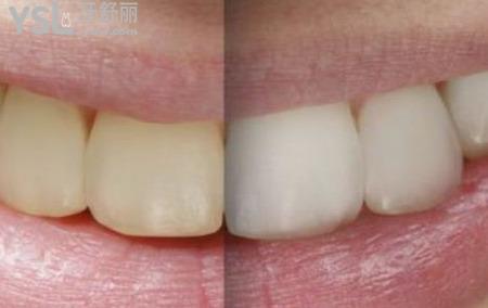 全瓷牙的優(yōu)點(diǎn)有哪些？
