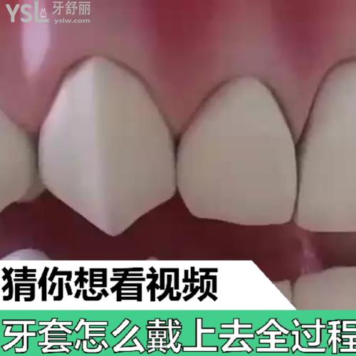 牙套怎么戴上去全過程，帶牙套難受不？