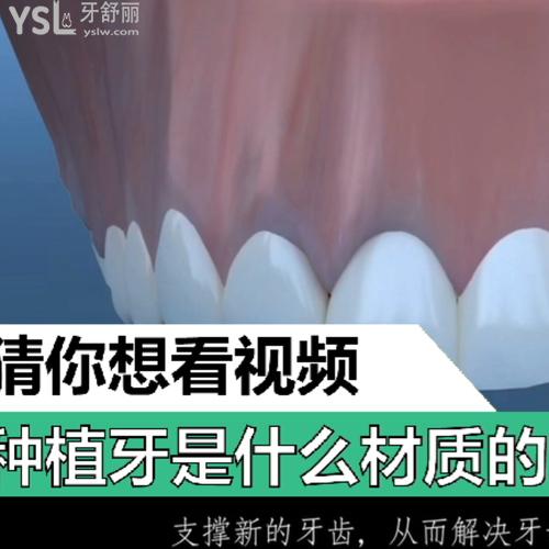種植牙是什么材質(zhì)的？