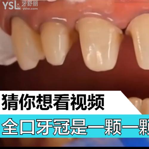 全口牙冠是一顆一顆的做的嗎？