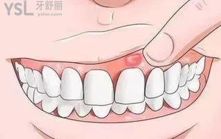 牙齦上面長了個泡怎么辦？