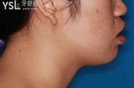 正頜手術(shù)是一個可怕的手術(shù)嗎？