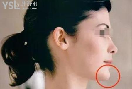 正頜手術(shù)有危險嗎？