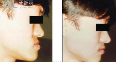 正頜手術(shù)多大才可以做？