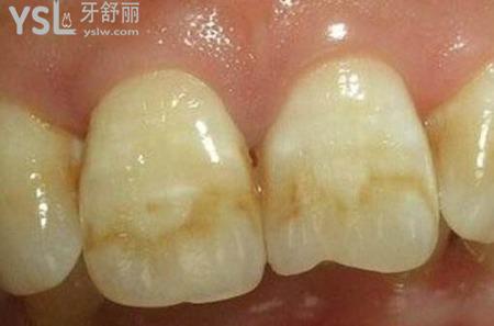 石斑牙怎么治療？