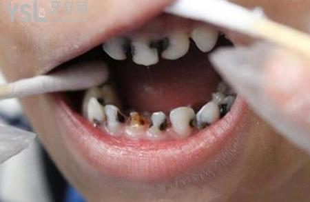 后槽牙里面凹陷處發(fā)黑怎么辦？