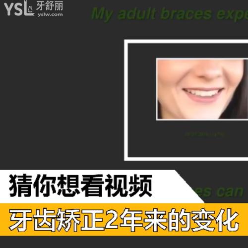 牙齒矯正2年來的變化