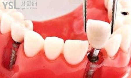 哪種假牙傷害最??？