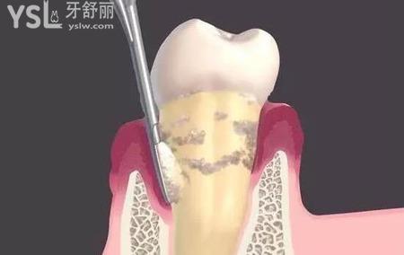 晚期牙周炎的表現(xiàn)是什么樣的？