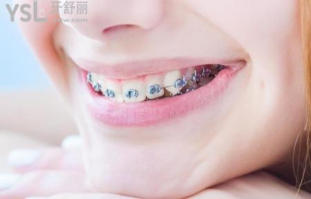 牙套斷裂用什么修復(fù)？