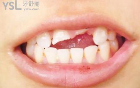 牙斷掉了牙根還需要拔掉嗎？