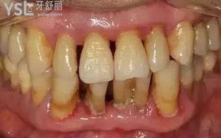 牙齦萎縮疼怎么辦？