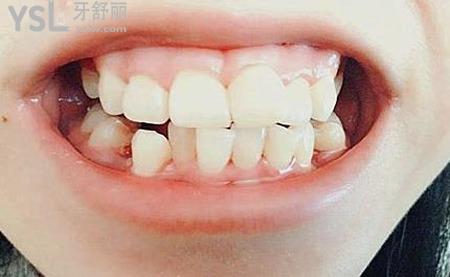正畸治療初期疼痛不適如何緩解？
