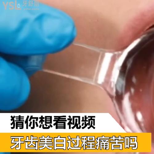 牙齒美白過(guò)程痛苦嗎？