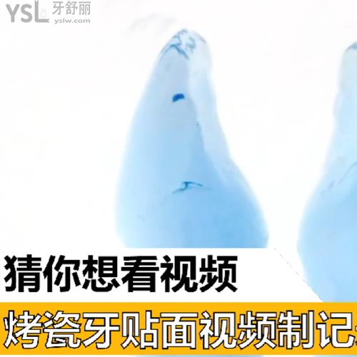 烤瓷牙貼面視頻制記錄制作過程