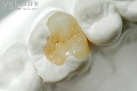 樹脂修復(fù)后牙根裸露是怎么回事？