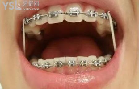 正畸牙齒移動的原理是什么？