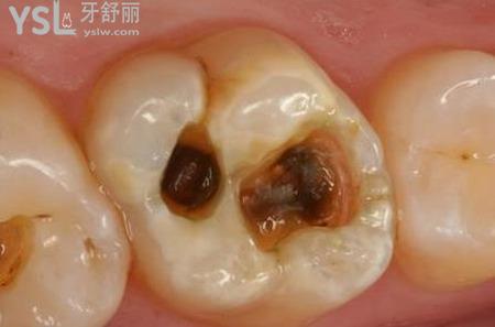 牙洞很深很黑是怎么回事？