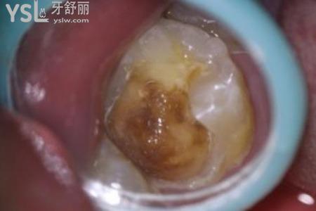 什么是光固化樹脂修復(fù)？