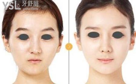 顴骨突出是怎么回事？