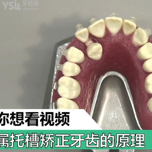 金屬托槽矯正牙齒的原理