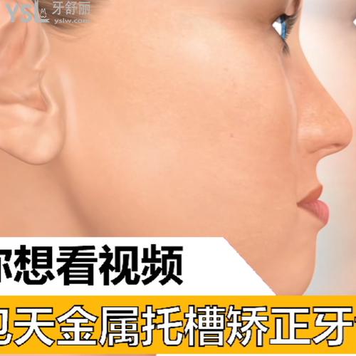 地包天金屬托槽矯正牙齒圖