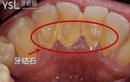 牙結(jié)石為什么會(huì)那么臭？