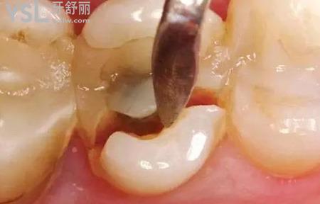 大牙掉了一小塊能長么？