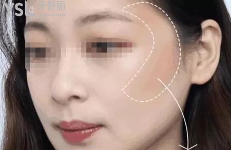 顴骨縮小手術(shù)方法有哪些？