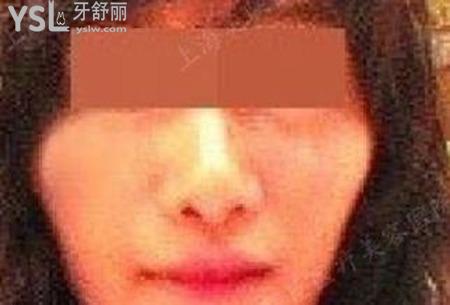 磨顴骨的危害是什么？