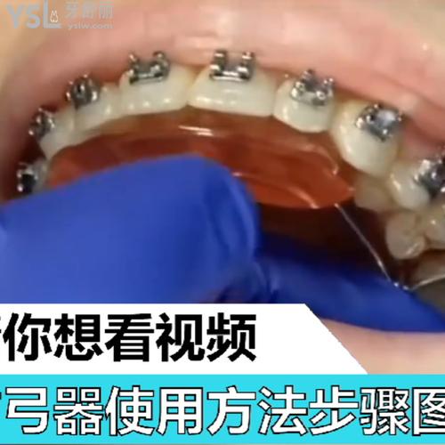 擴(kuò)弓器使用方法步驟圖解視頻