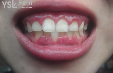 牙齦癢是什么原因？