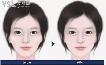 顴骨內推手術后能正常發(fā)言嗎？